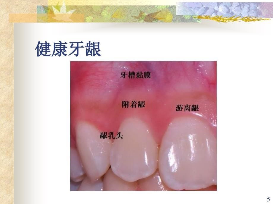 最新口腔内科学5牙周组织病PPT文档_第5页