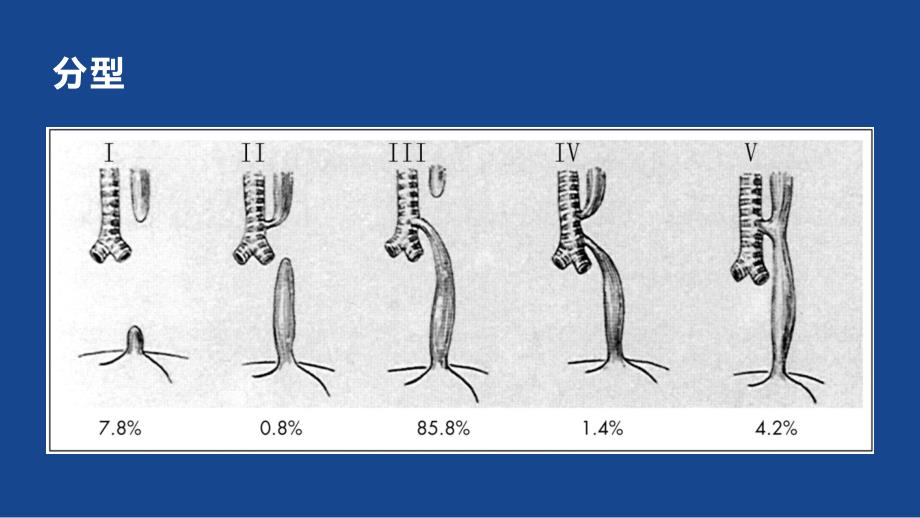 先天性上消化道畸形.ppt_第4页