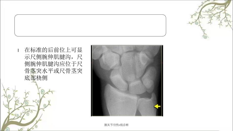 腕关节创伤x线诊断_第4页
