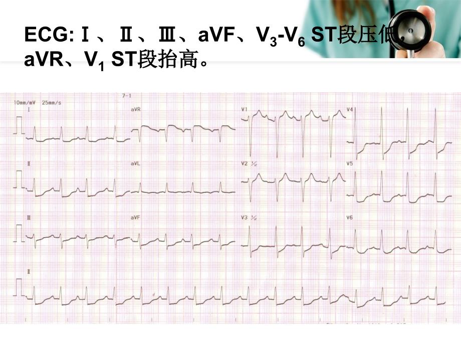 重视左主干病变心电图价值_第4页