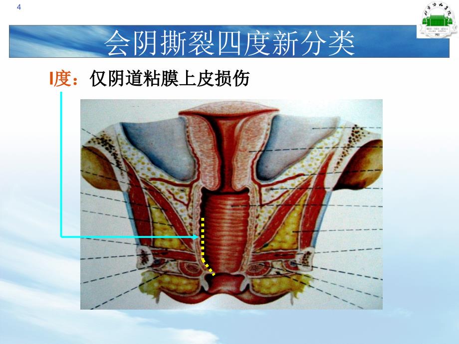 四度会阴撕裂新技术介绍_第4页