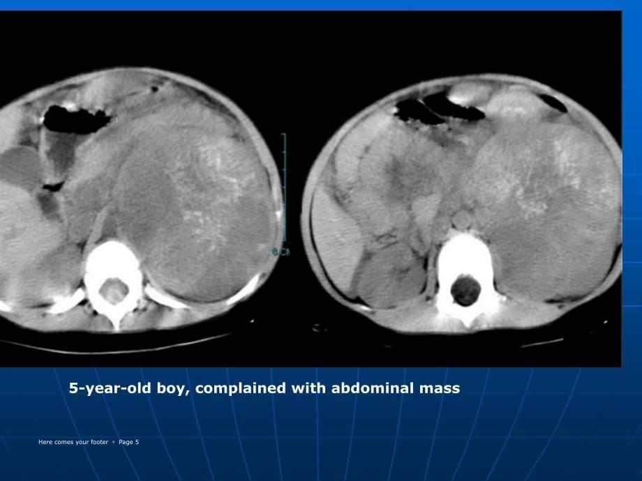 常见肾上腺肿瘤的ct诊断与鉴别诊断课件_第5页
