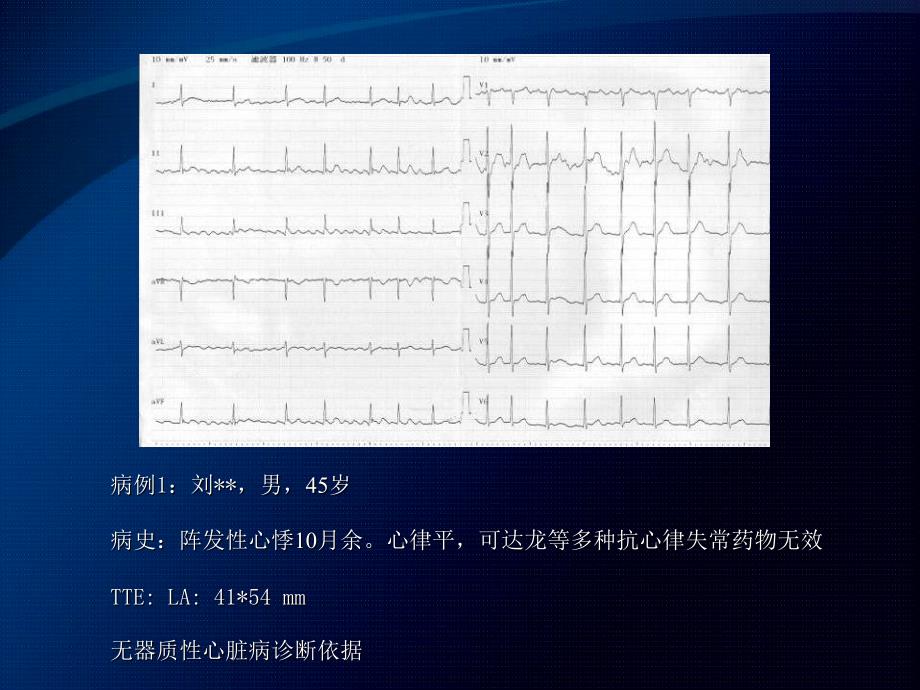 心房颤动消融后房扑的再消融杨东辉课件_第3页