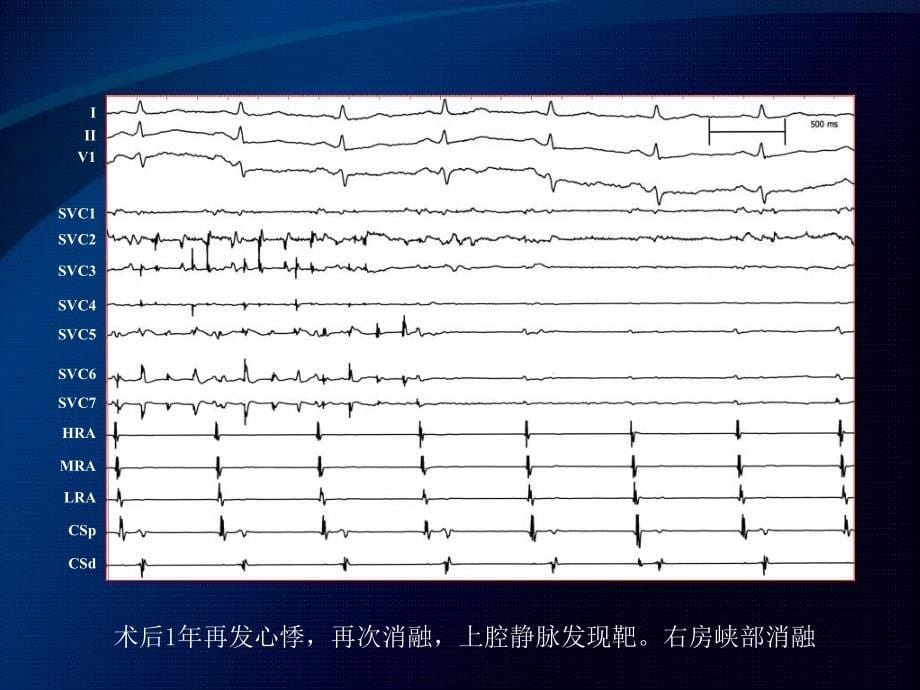 心房颤动消融后房扑的再消融杨东辉课件_第5页