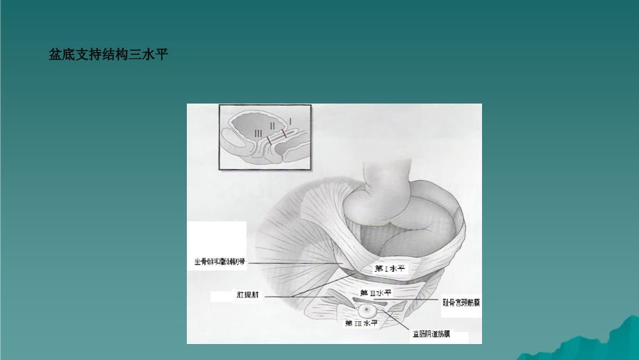 盆腔器官脱垂干货分享_第4页