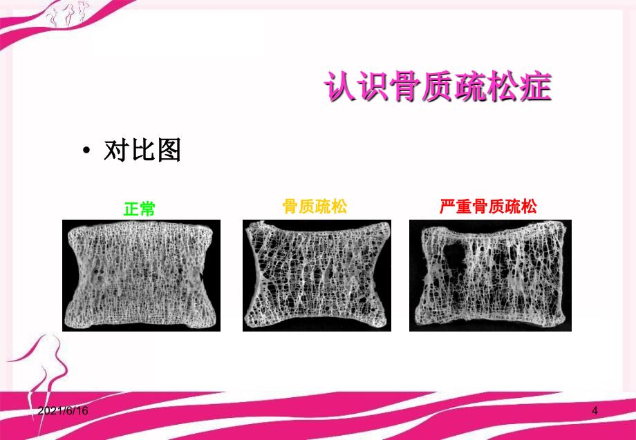 骨质疏松症概论课件_第4页