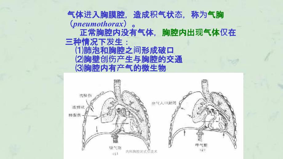 内科胸腔闭式引流术课件_第3页