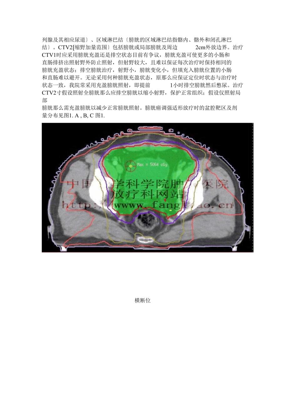 膀胱癌的放射治疗建议版_第2页