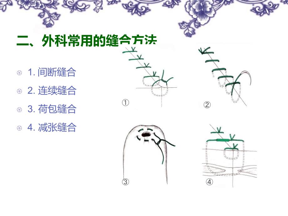 手术缝合线04_第4页