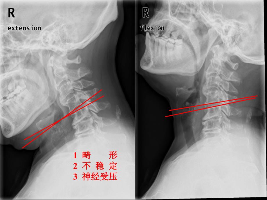 颈椎病手术决策ppt课件文档资料_第4页