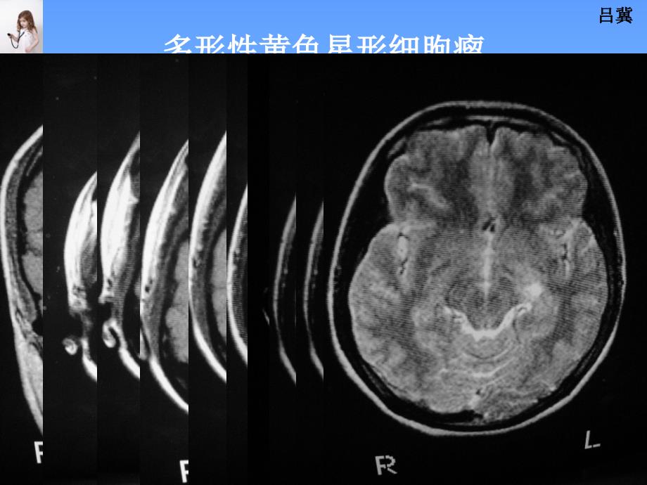 医影在线CNS疾病MRI诊断(6)_第2页