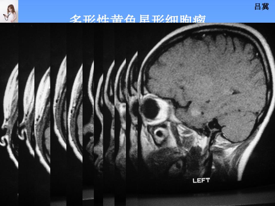 医影在线CNS疾病MRI诊断(6)_第3页