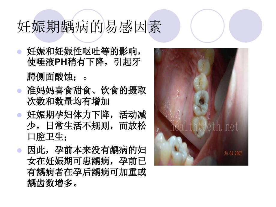 妊娠期口腔保健知识普及课件_第4页