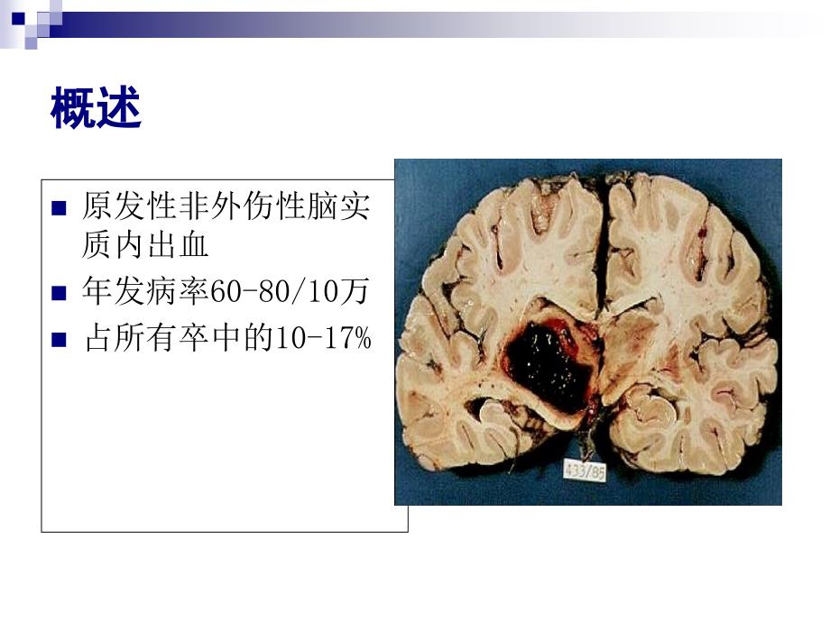 脑出血intracerebralhemorrhageICH文档资料_第1页