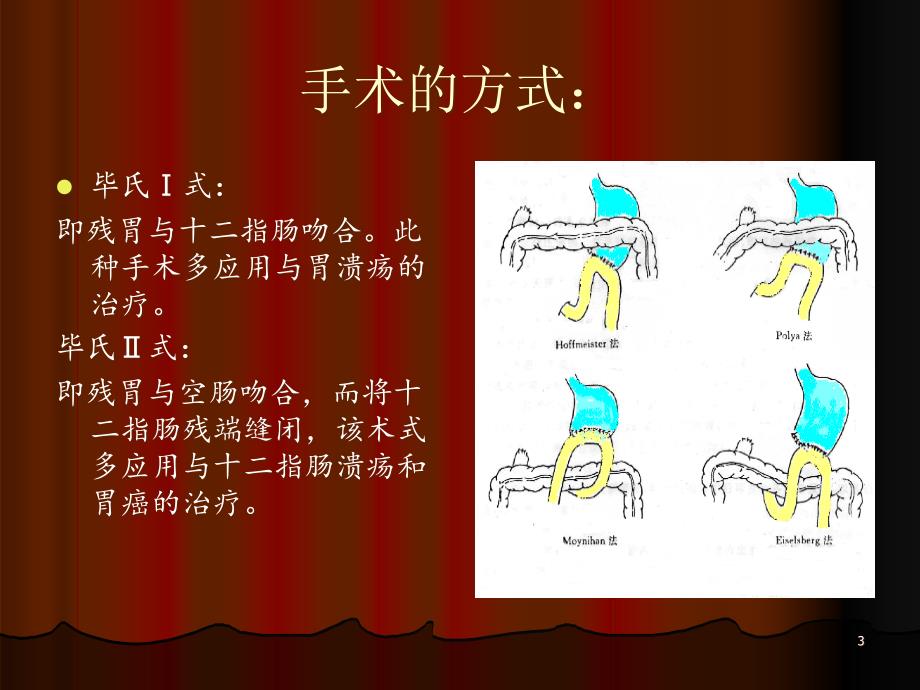 胃大部切除术后的护理PPT医学课件_第3页