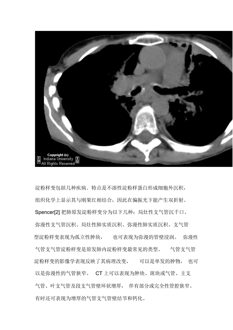 支气管淀粉样变性_第3页