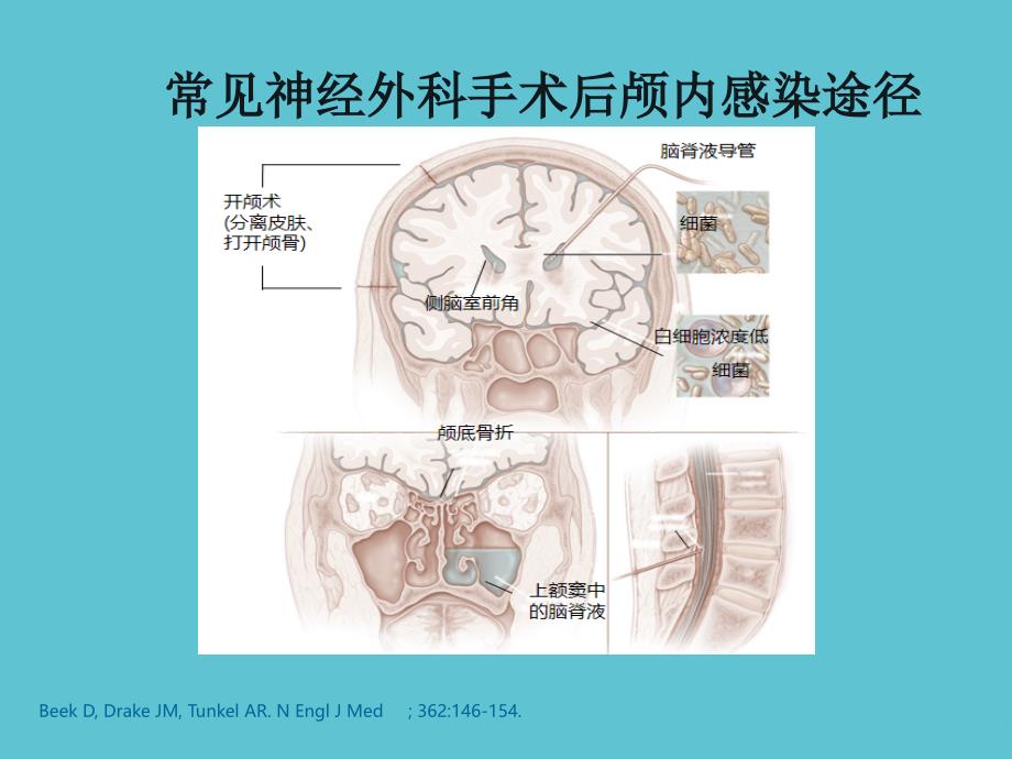 完整颅内感染诊疗策略资料PPT课件_第4页