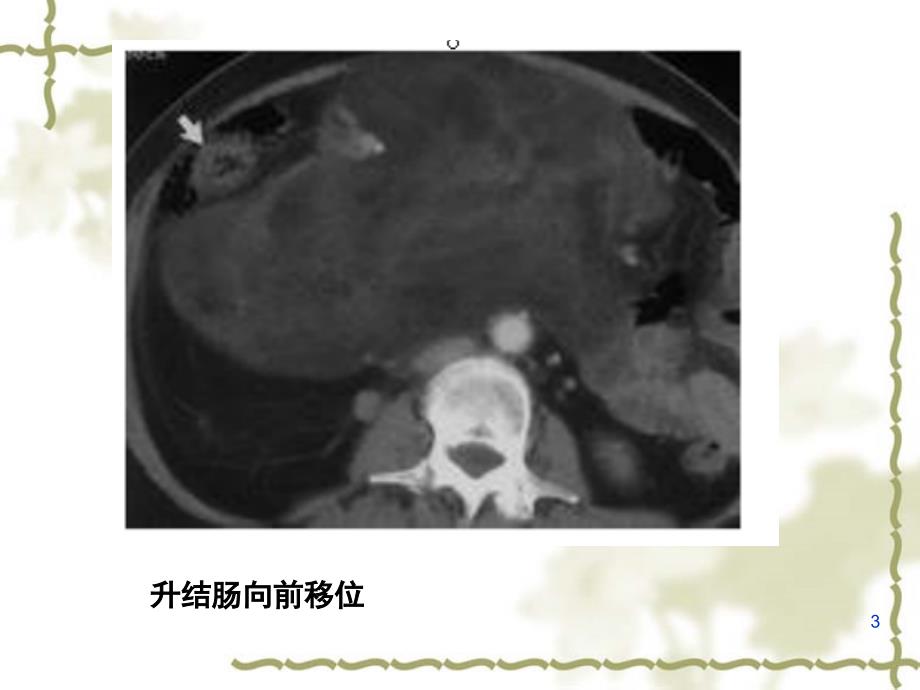 腹膜后神经源性肿瘤课堂PPT_第3页