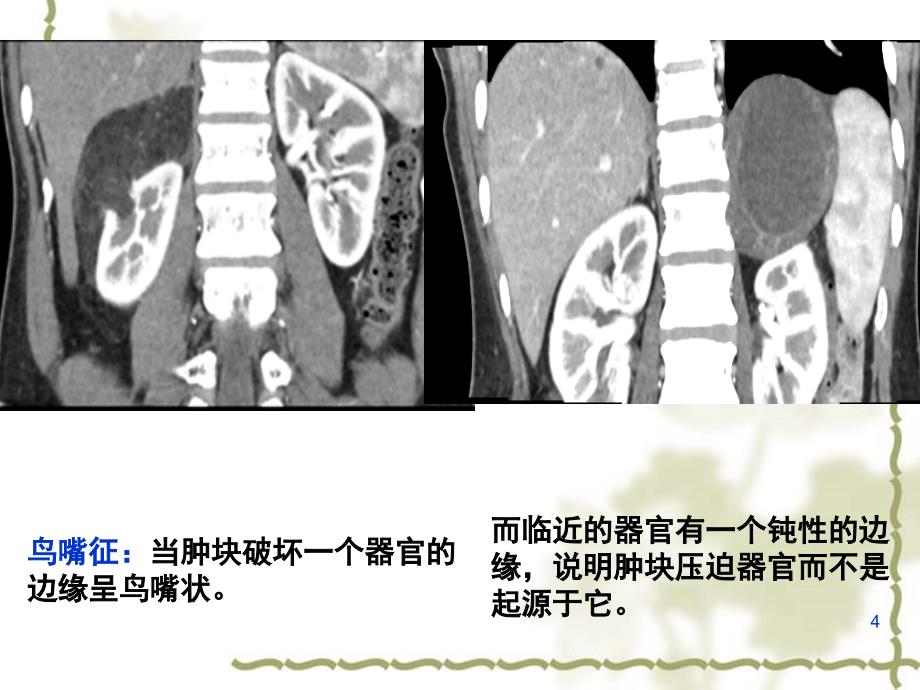 腹膜后神经源性肿瘤课堂PPT_第4页