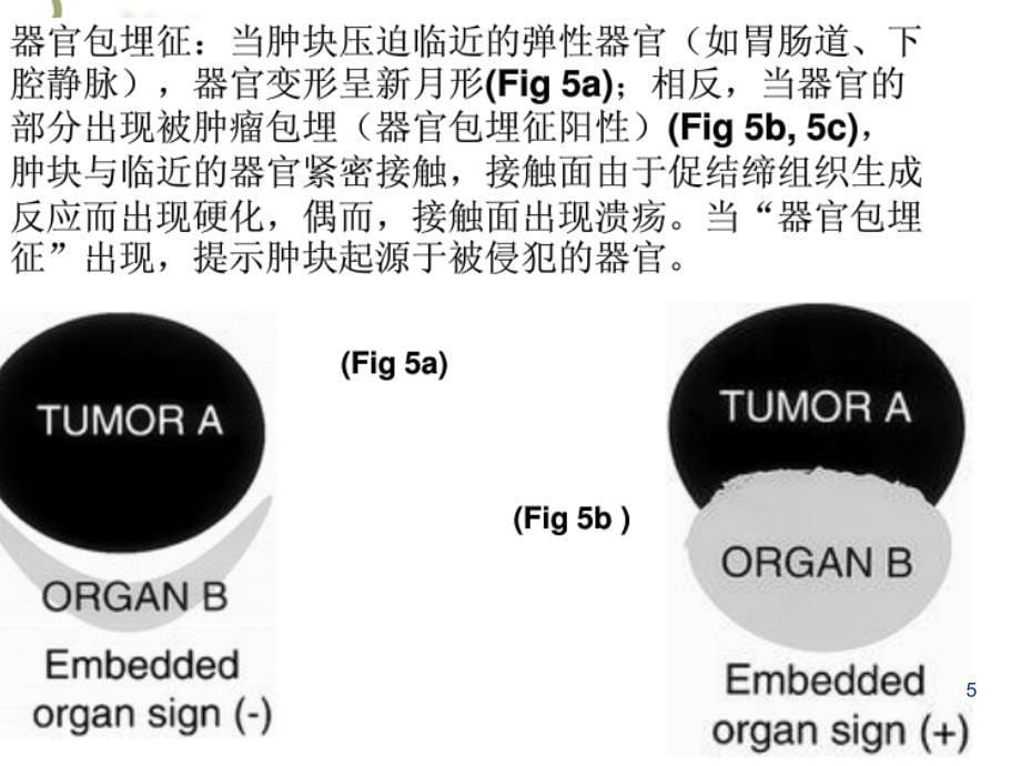 腹膜后神经源性肿瘤课堂PPT_第5页