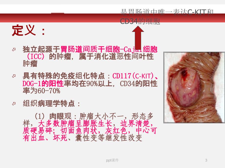 胃肠间质瘤ppt课件_第3页