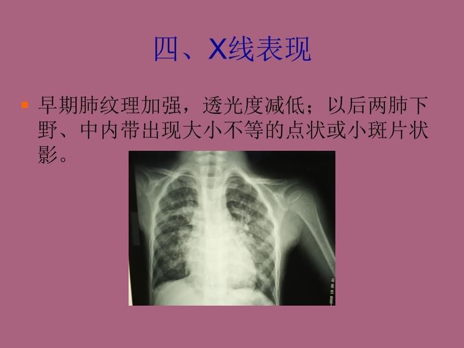 肺炎及肺炎合并心衰ppt课件_第5页