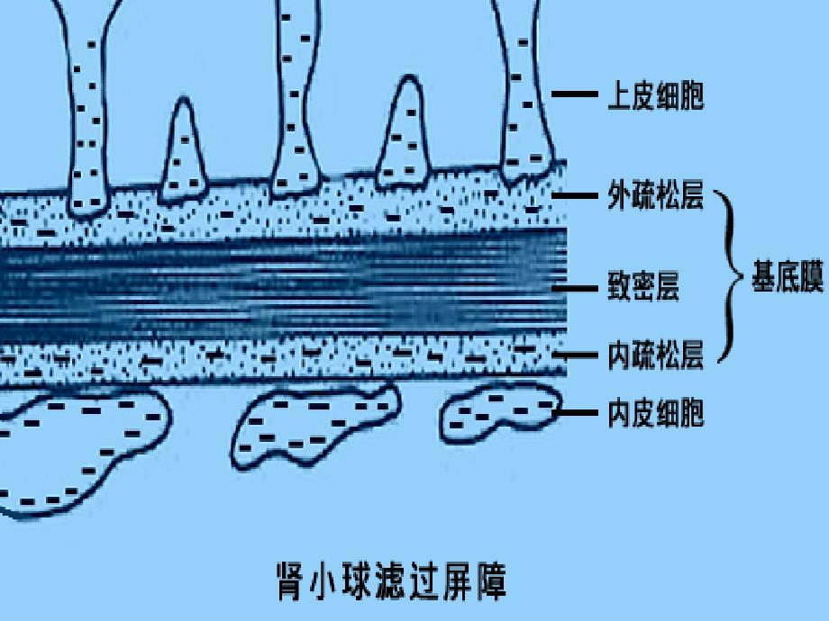 急性肾小球肾炎-教学课件_第3页