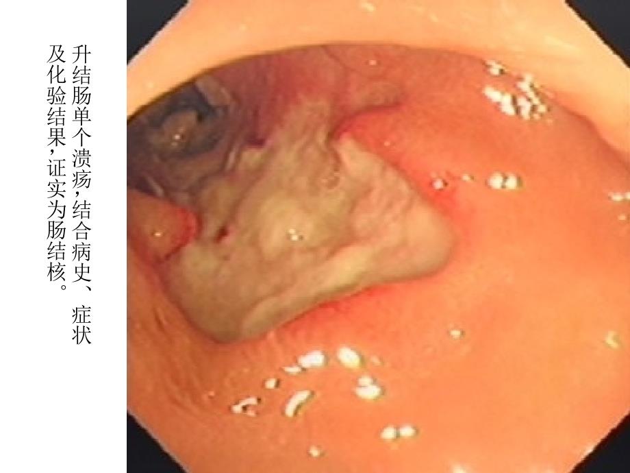 腹部结核PPT课件_第3页