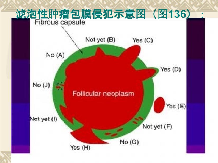 滤泡性甲状腺癌包膜侵犯的判断标准_第3页