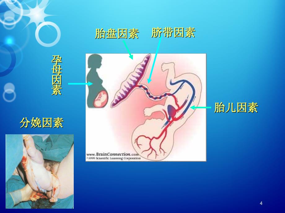 新生儿窒息ppt课件_第4页