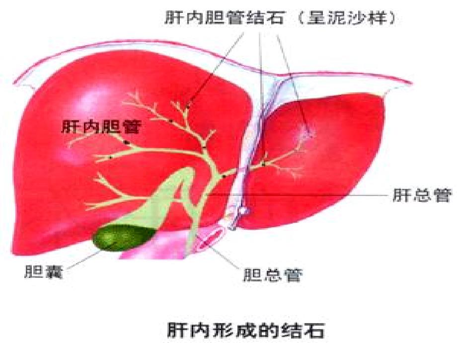 肝内外胆管结石病人的护理_第4页