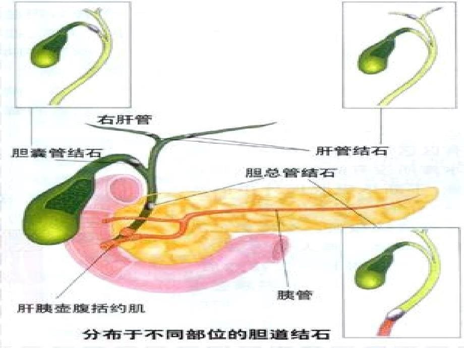 肝内外胆管结石病人的护理_第5页