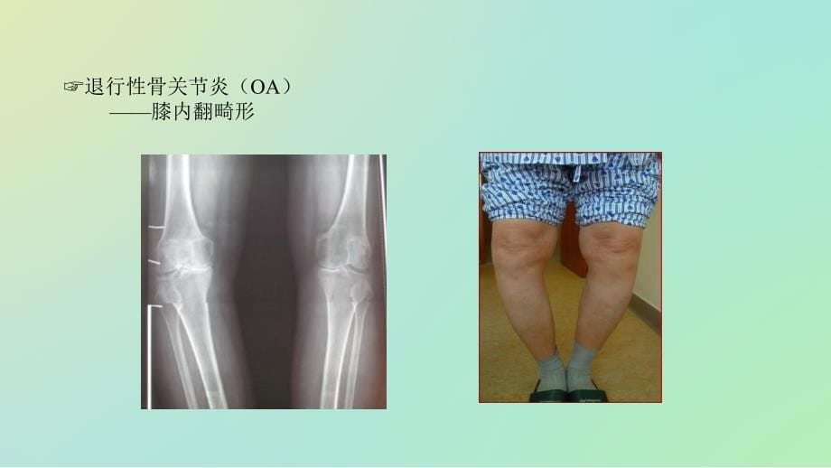 全膝关节置换术的围手术期护理课件_第5页