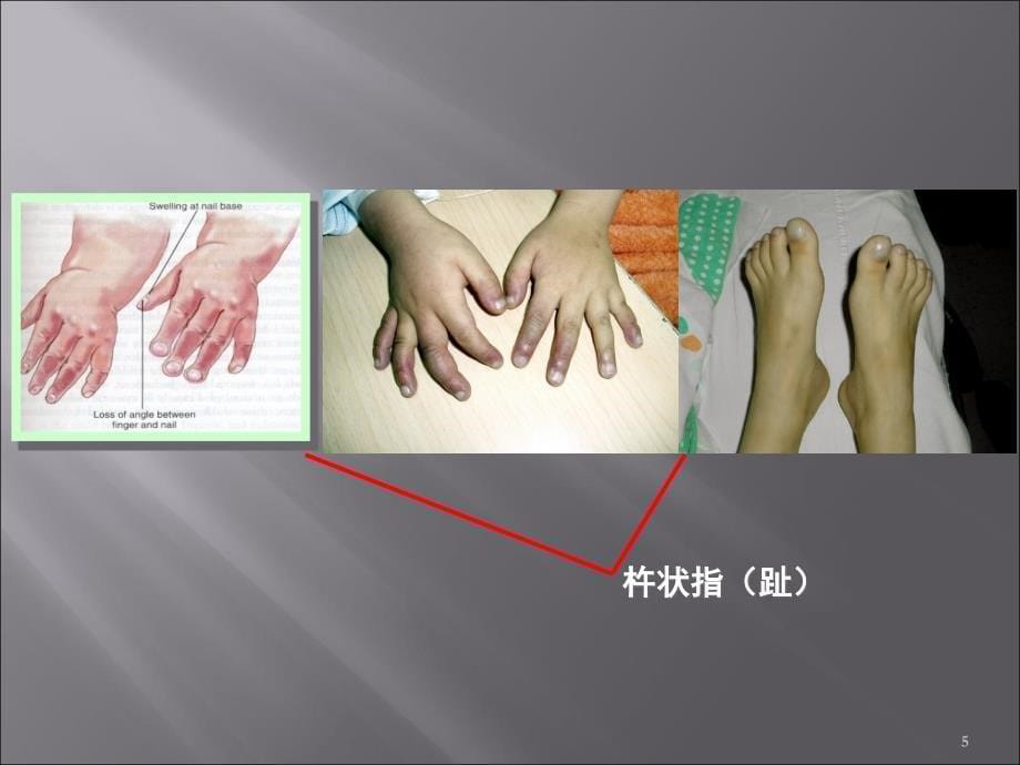 先天性心脏病再稿ppt课件_第5页