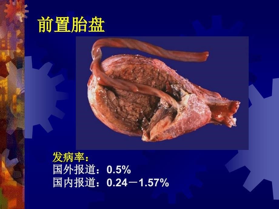 妇产科学课件-前置胎盘_第5页