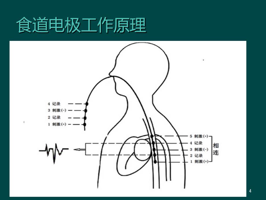 食道调搏术精美PPT课件_第4页