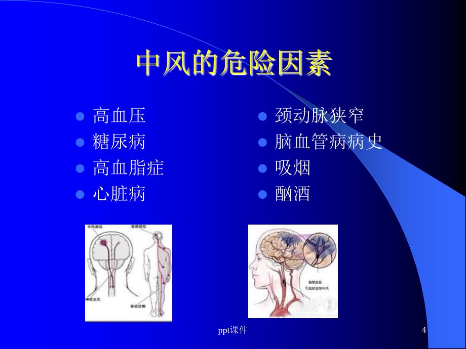 中风患者的康复治疗ppt课件_第4页