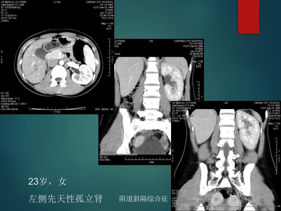 泌尿系统先天发育异常影像表现_第5页