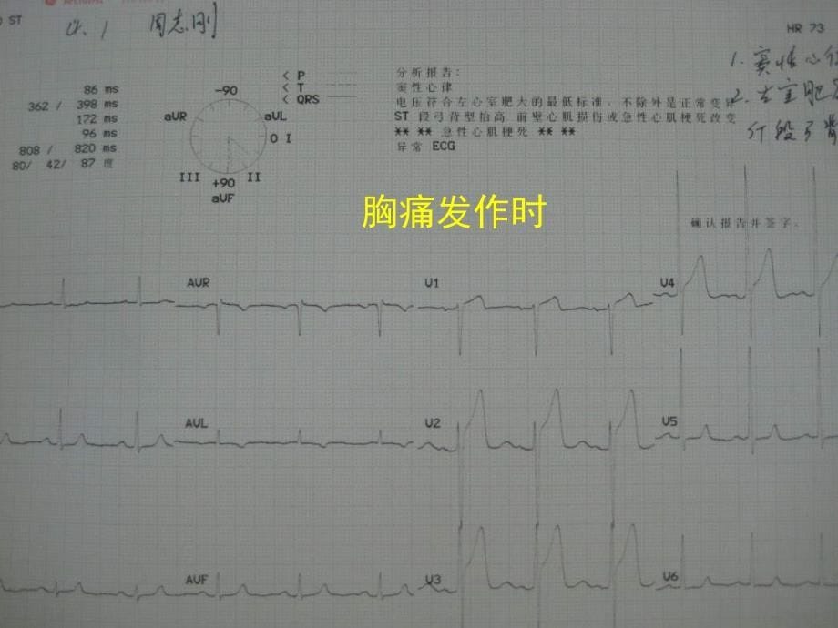 冠状动脉斑块迅速进展PCI一例分析_第5页