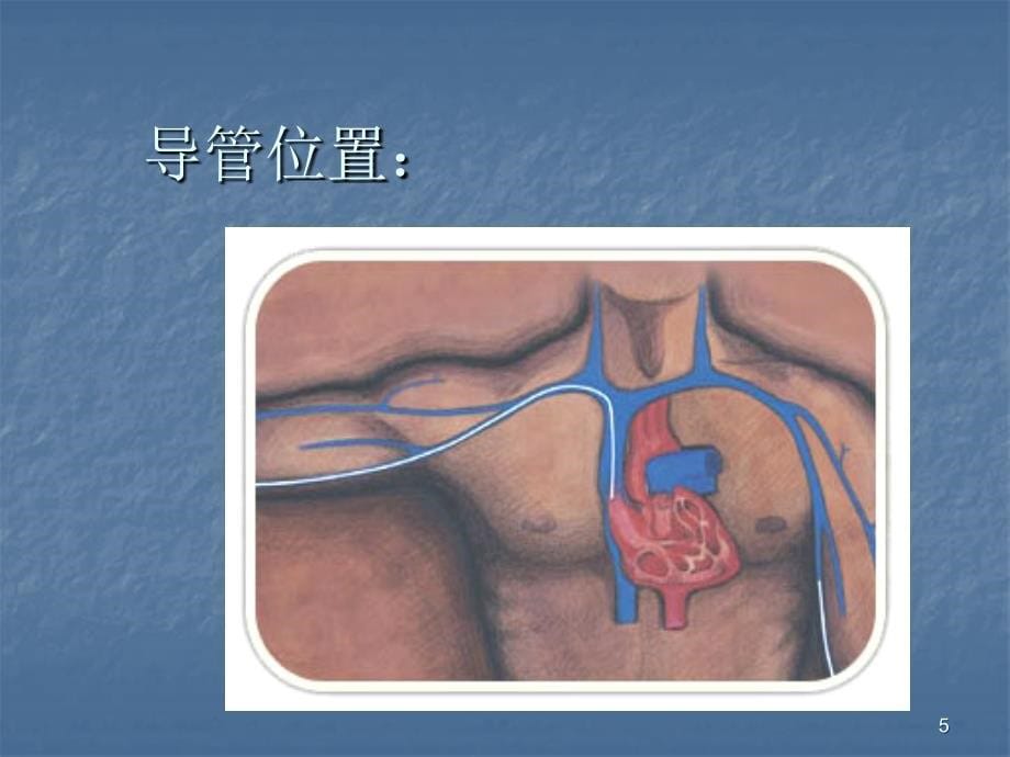 PICC置管的护理ppt课件_第5页