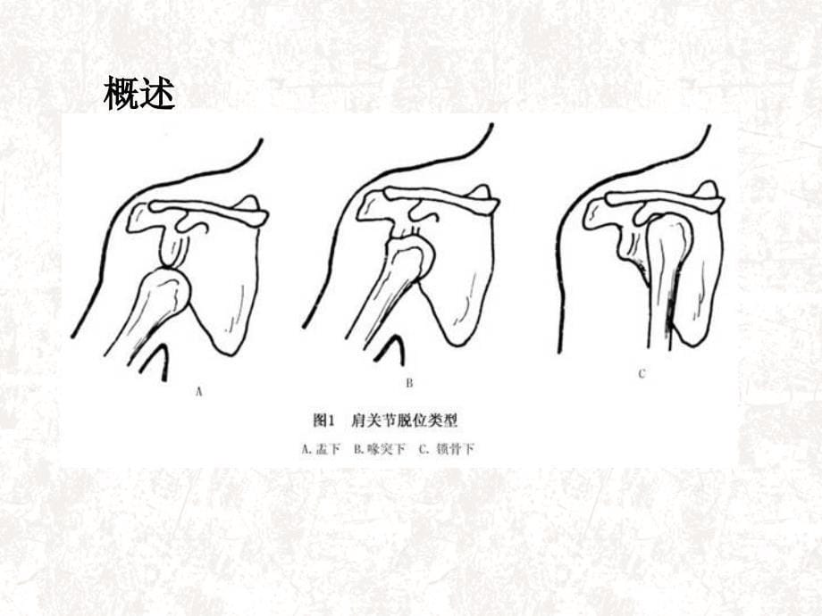 创伤性肩关节前脱位_第5页