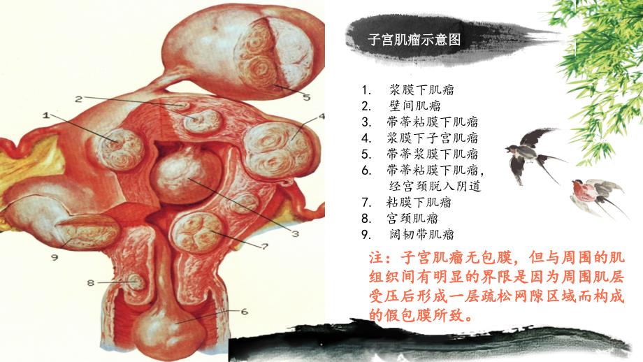 医学课件子宫肌瘤超声诊断_第3页