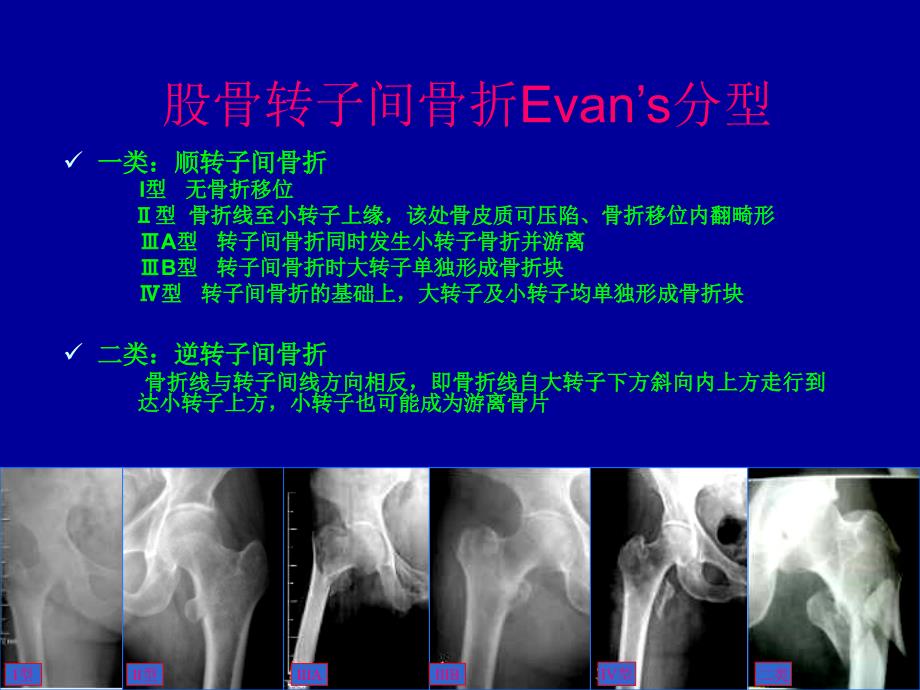 股骨近端髓内钉_第5页