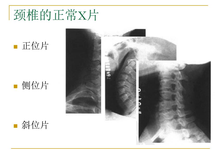 脊柱X片的诊断_第3页