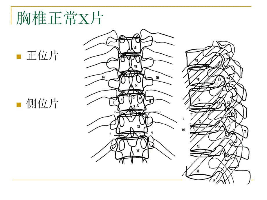 脊柱X片的诊断_第4页