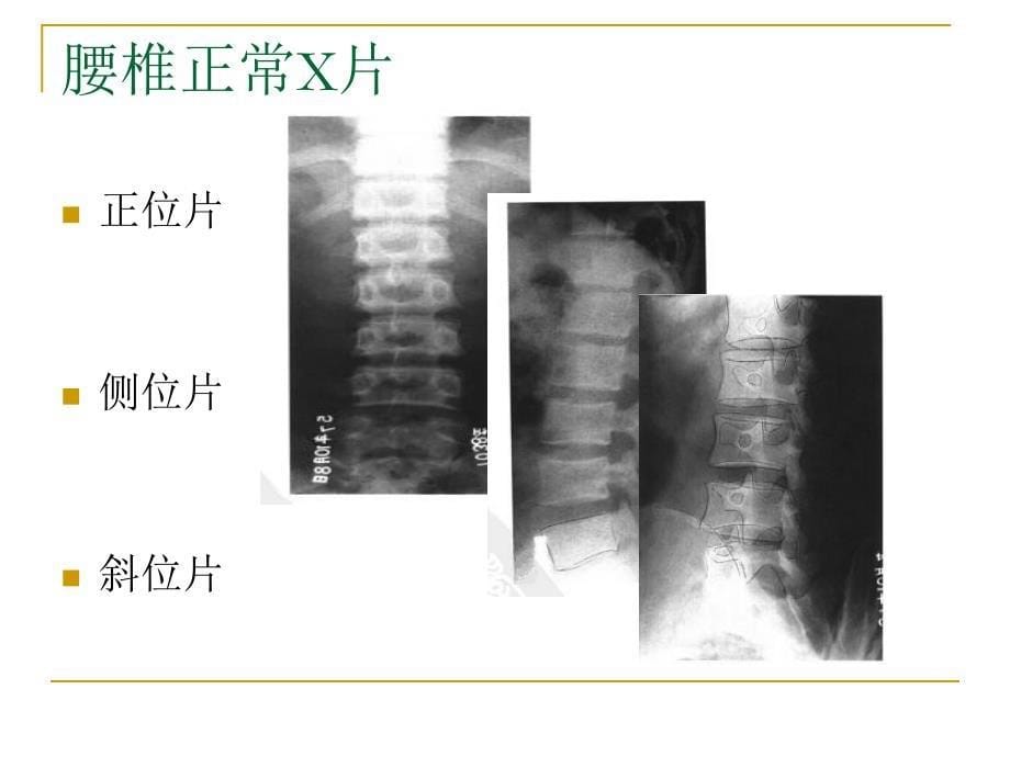 脊柱X片的诊断_第5页