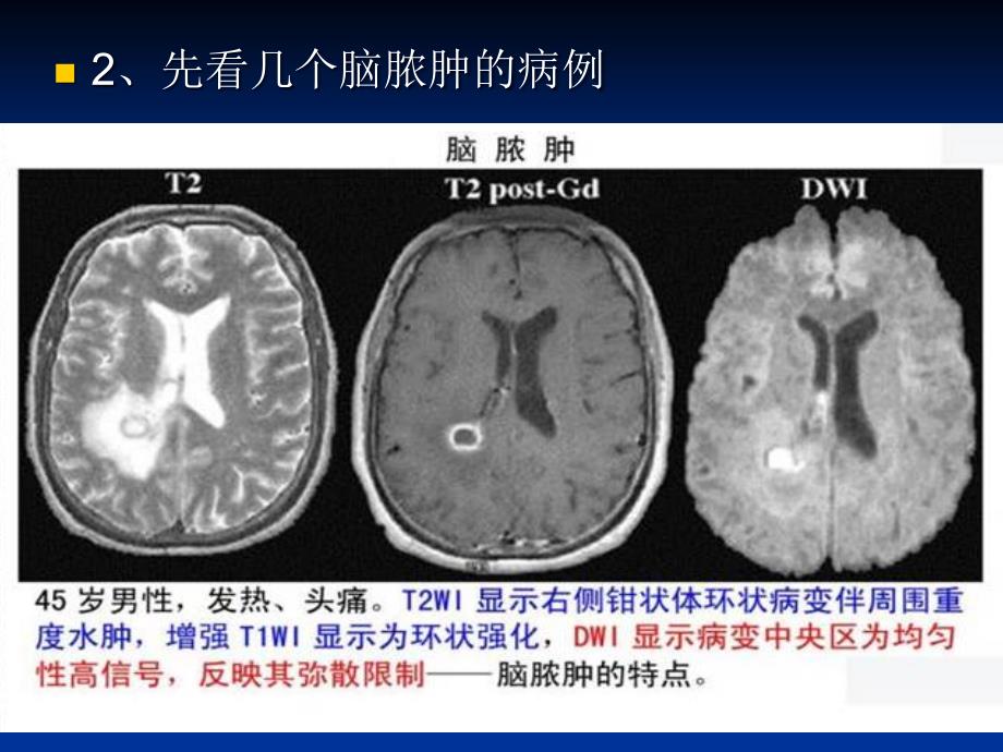 DWI在神经系统的临床应用ppt课件_第3页