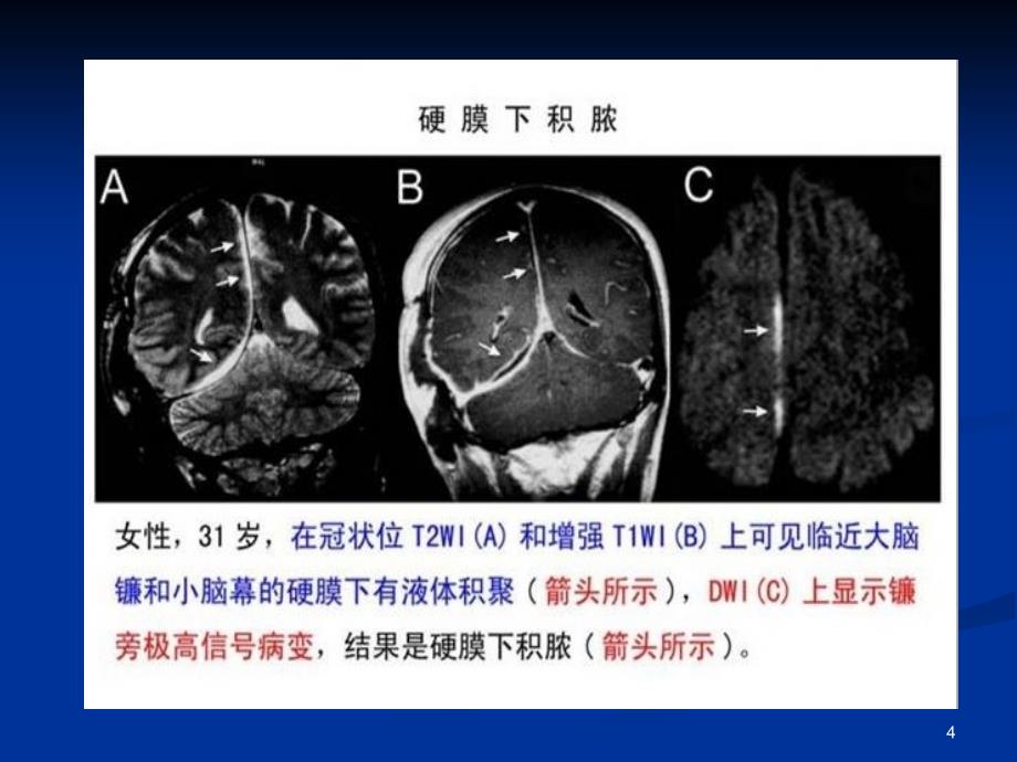 DWI在神经系统的临床应用ppt课件_第4页