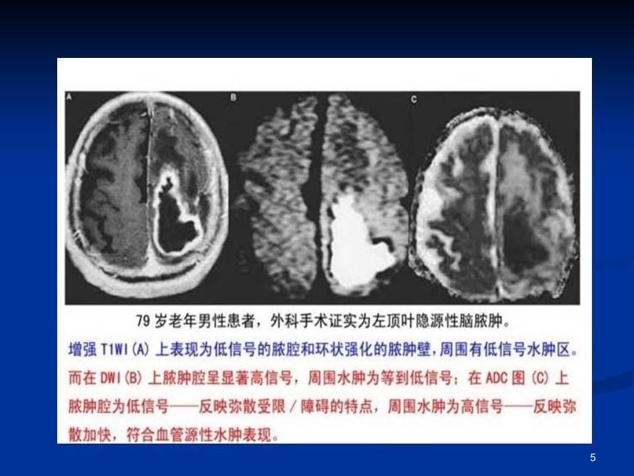 DWI在神经系统的临床应用ppt课件_第5页