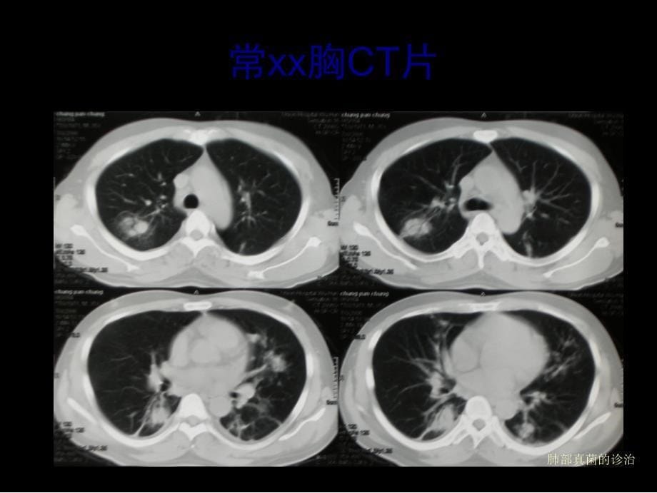 肺部真菌的诊治课件_第5页